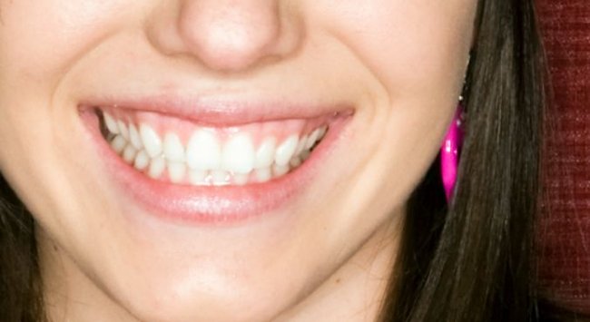 BreezeCare Patients Take Part In GC Tooth Mousse Study